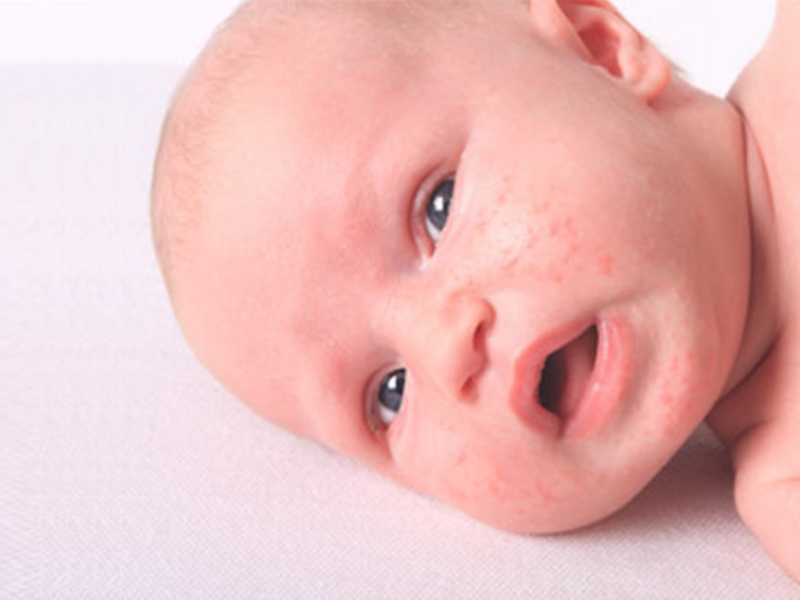 Потниця - найчастіша літня проблема у малюків
